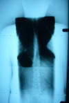 spinecor brace