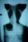 spinecor brace