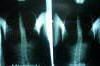 Spinecor Brace