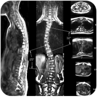 scolioscreening